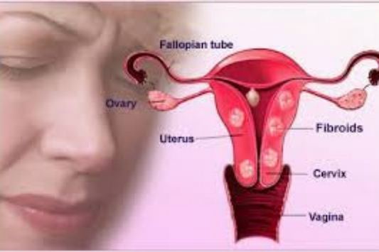 Endometriosis Steaming Herbs